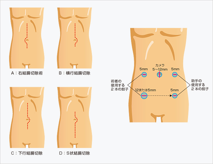 腹腔 鏡 手術 後 お腹 の 張り